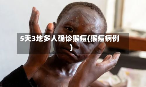 5天3地多人确诊猴痘(猴痘病例)-第2张图片