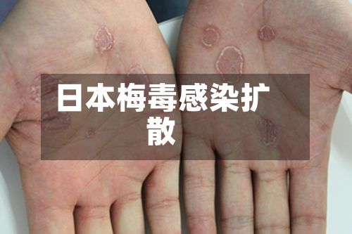 日本梅毒感染扩散-第3张图片