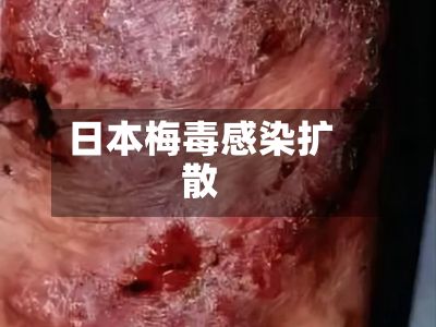 日本梅毒感染扩散-第2张图片